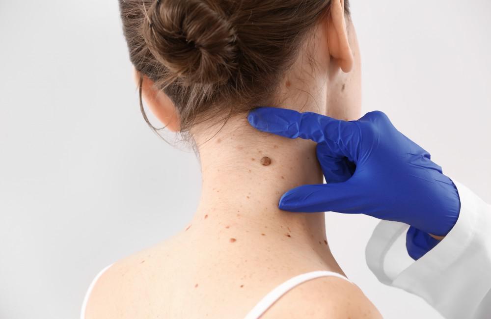 Many people in Bristol opt for professional skin tag removal Bristol services to ensure the procedure is safe, quick, and minimally scarring.