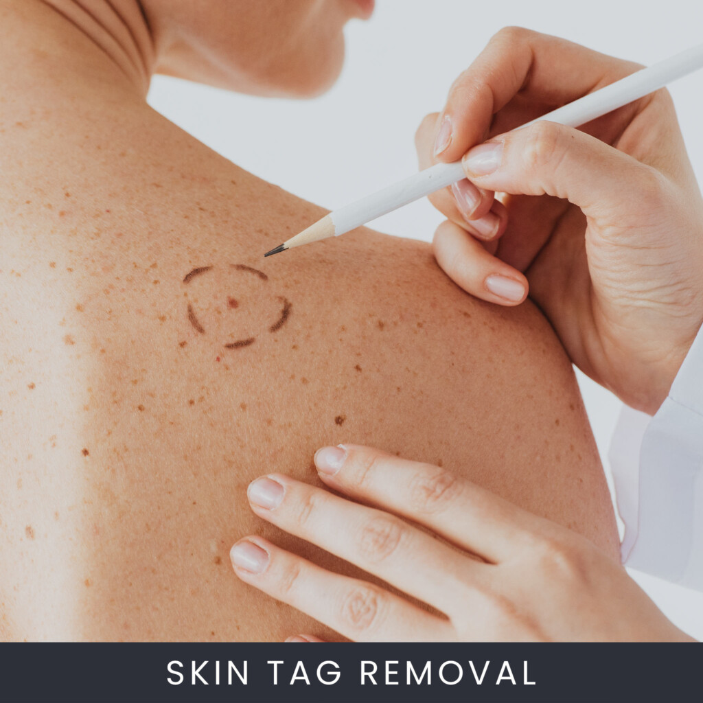 Skin-Tag-Removal-